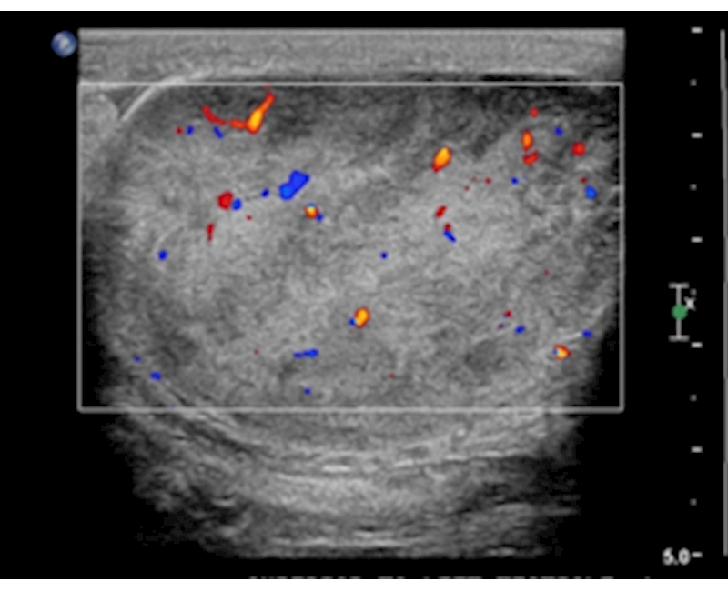 Scrotal liposarcoma: Sonography case report of a rare extratesticular mass